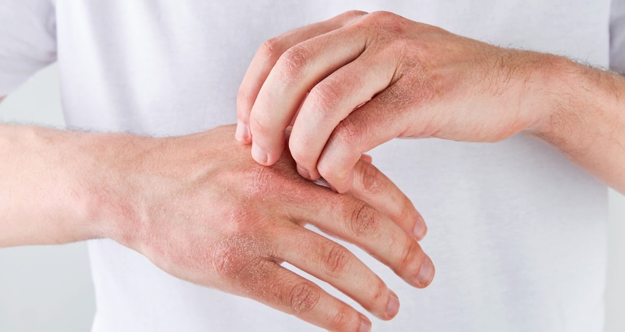 ‘Kuru cilt’ böbrek hastalıklarında belirti olabilir