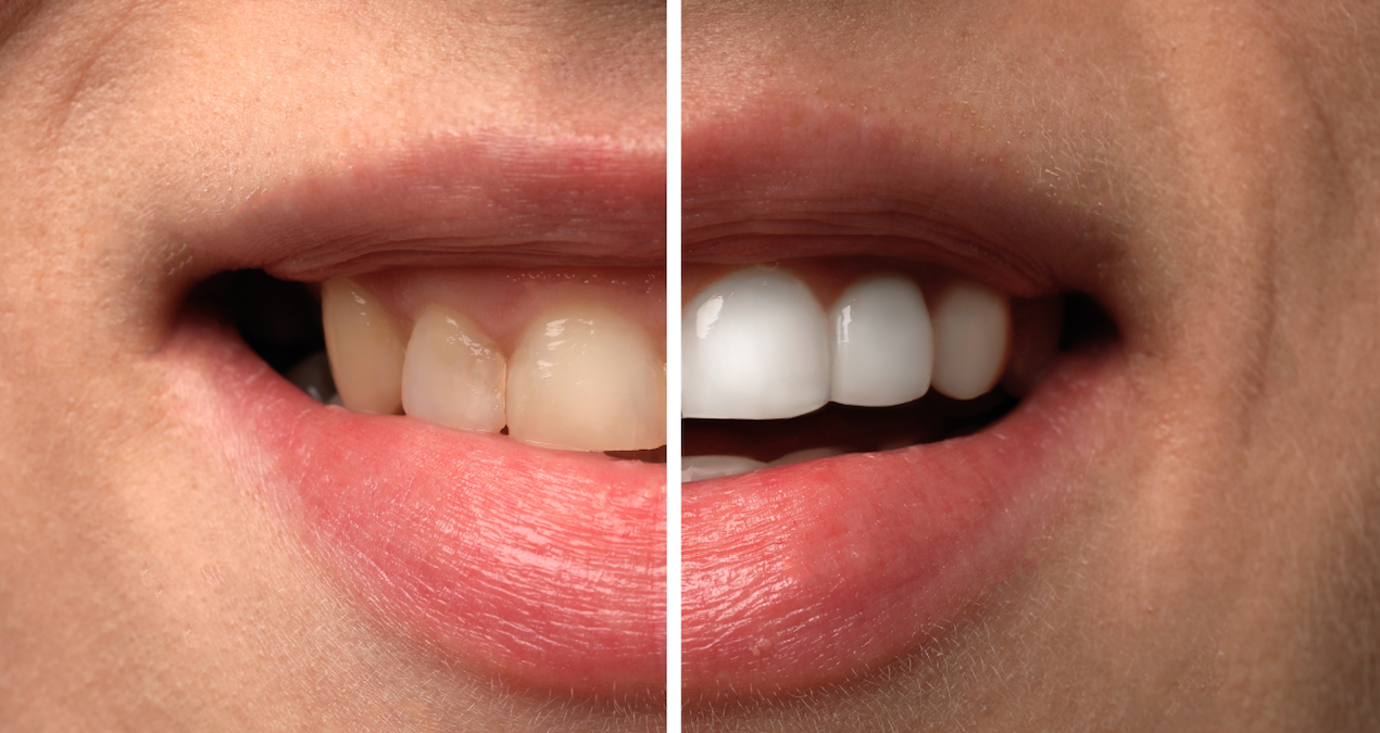 Masum gibi görünen 8 yiyecek dişleri sinsi sinsi çürütüyormuş